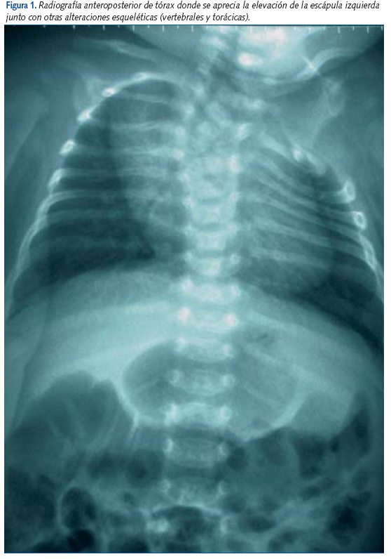Figura 1. Radiografía anteroposterior de tórax donde se aprecia la elevación de la escápula izquierda
junto con otras alteraciones esqueléticas (vertebrales y torácicas).